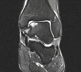 Abbildung 1: Osteochondrale Läsion der medialen Talusschulter mit subchondralem Begleitödem und Zyste.