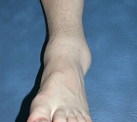 „Dickes“ Sprunggelenk nach Trauma.