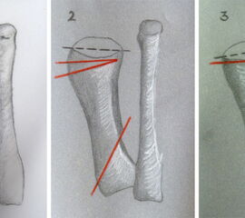 Basisosteotomie, PASA Veränderung und Korrekturmöglichkeit- (Schemazeichnung)