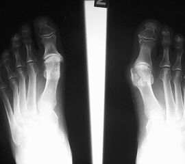 Röntgenbild 30 Jahre nach Brandes OP links zur OP Planung rechts.