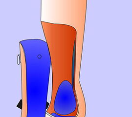 Prothese für die Versorgung nach Syme-Amputation