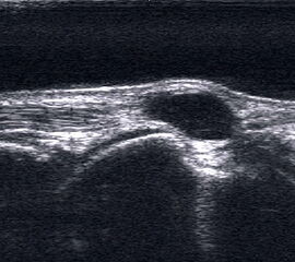 Ganglien imponieren als runde, echofreie Raumforderungen.