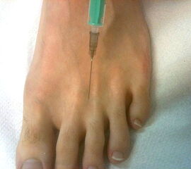 Perineurale Infiltration von dorsal