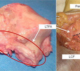 Links der Ansatz des Ligamentum talofibulare anterius (LTFA) am Talus. Dieses Band verläuft in Neutralstellung des OSG fast horizontal. Rechts ist zudem das Ligamentum calcaneofibulare (LCF) abgebildet, das in ca. 120° zum LTFA verläuft.