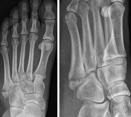 Lawrence und Botte Zone I