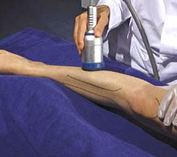 Mm. peronei: Behandlung mit der fokussierten Stoßwelle am lateralen Unterschenkel. Fokustiefe 30 mm. (Mit frdl. Genehmigung durch Level-10-Buchverlag, Heilbronn und Storz Medical AG)