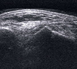 Echogene Verdickung im Subkutangewebe bei Lymphödem