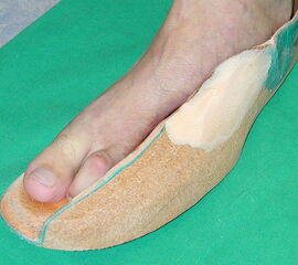 Einlage mit eingearbeitetem Spacer zum Ausgleich einer Amputation des 3. bis 5. Metatarsale bei einem Synovialsarkom.