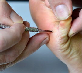 Inzision unterhalb der plantaren Beugefalte der 5. Zehe zur Beugesehnentenotomie.