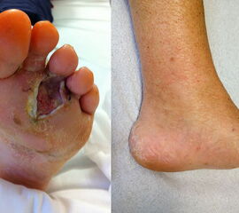 Befund nach R1-Resektion eines Rezidivs eines akrolentiginösen malignen Melanoms mit plantarer Defektwunde (links) und postoperativer Zustand nach Lisfranc-Amputation (rechts).