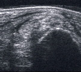 Peronealsehnenluxation. TS an der Fibulaspitze. Die Sehnen sind über die Fibula gerutscht.