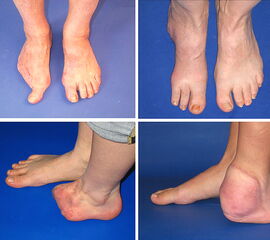 Wichtige Amputationshöhen im Fuß (Zehenamputation, Teilamputation, Vorfußamputation, Rückfußamputation)