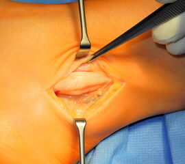 Vollständig luxierte Peroneaus longus Sehnen mit Verlauf über die Fibula.