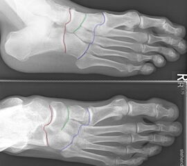 Unter den Mittelfußbereich fällt die Lisfranc- (blau), die Bona-Jäger- (grün) und Chopart- (rot) Gelenkreihe