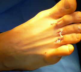 Korrektur der Kleinzehen durch einen Beugesehnen-Transfer nach Girldestone-Taylor.