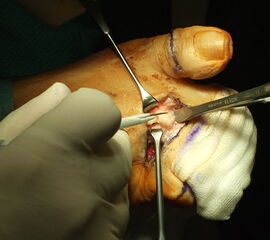 Dorsaler Zugang zur Resektionsarthroplastik der Mittelfußköpfchen 2-5.