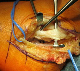 Eine Knochenschuppe nach Fraktur kann zu einer chronischen Schädigung der Peronealsehnen führen.