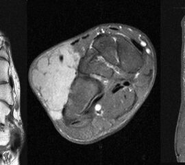 MR-tomographische Darstellung eines unspezifischen weichteiligen Raumforderug im Bereich des dorso-lateralen Rückfußes. Die offene Probebiopsie ergab schließlich die Diagnose eines hochmalignen Synovialsarkoms.