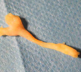 Kernspintomografisch nicht nachweisbares Nervenentrapment (sanduhrförmige Einengung)