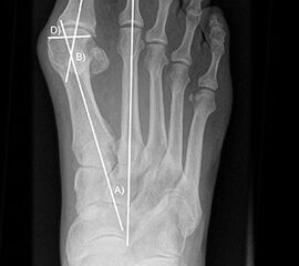 Präoperatives Röntgenbild Fuß d.p. mit eingezeichneten Winkeln. A) Intermetatarsalwinkel, B) Hallux valgus Winkel, C) Interphalangeal-Winkel.