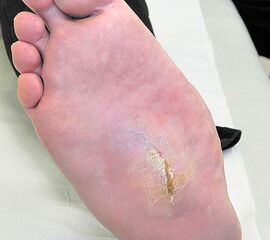 Rhagade bei einem Patienten mit lokaler, druckbedingter Hyperkeratose bei Diabetes mellitus Rhagade bei einem Patienten mit lokaler, druckbedingter Hyperkeratose bei Diabetes mellitus