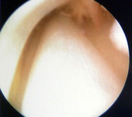 Tendoskopie der Peronealsehnen. Aufgrund der engen Raumverhältnisse sind die therapeutischen Möglichkeiten limitiert.