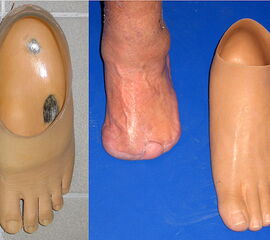 Knöchelfreie prothetische Versorgung von langen Fußwurzel- und kurzen Mit telfußstümpfen (Bellmann-Prothese li.; Silikon-Vorfußprothese re.)