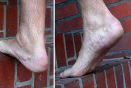 Exzentrisches Krafttraining an einer Stufe mit 6x15 Wiederholungen pro Tag und Bein mit Halten jeder Position für 2s über 12 Wochen täglich.