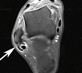 MRT mit KM bei Split der Peronaeus brevis Sehne in Höhe der Fibulaspitze