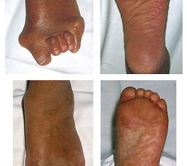 Präoperatives Bild eines schwer deformierten Vorfußes und das Ergebnis ein Jahr postoperativ nach Stainsby Prozedur.