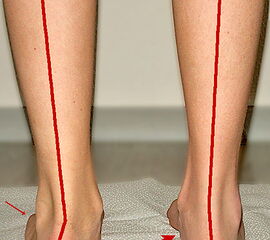 Die Fotodokumentation zeigt die Füße eines 13-jährigen Jungen. Das Bild ermöglicht den klinischen Vergleich zwischen dem operierten Pes planovalgus rechts und dem Befund vor noch ausstehender Operation links.