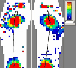 Hohlfuß mit Druckspitzen in der Fersenregion und Vorfußbereich. Der Mittelfuß nicht belastungstragend in die Schrittabwicklung integriert.
