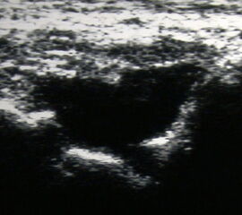 Echofreie Vorwölbung der Gelenkkapsel durch einen Gelenkerguss mit osteophytären Ausziehungen am Knorpel-Knochen-Übergang.