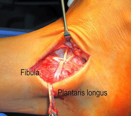 Anatomische Rekonstruktion einer chronischen Instabilität mit einem Plantaris longus Transplantat. Entsprechend der antomischen Insertion wird das Sehnentransplantat über Bohrkanäle in Talus, Fibula und Calcaneus verankert um einen physiologischen Bandverlauf sicherzustellen.