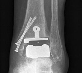 Osteosynthese eines intraoperativ frakturierten medialen Malleolus mit perkutanen Schrauben.