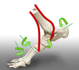 Dekompensation der gesamten Fußmechanik bei Rückfußvalgus.