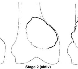 Schematische Darstellung der Enneking Klassifikation gutartiger Knochenläsionen