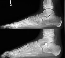 Röntgenkontrolle d.p. und seitlich unter Belastung nach 2, 6 und 12 Wochen und Beurteilung des Ergebnisses im Vergleich mit den präoperativen Bildern.