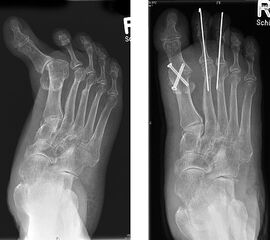 Arthrodese MTP I und weichteilige Rezentrierung MTP II und III (eigenes Bildmaterial)