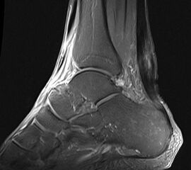 Schwere Veränderungen der Binnenstruktur der Achillessehne im MRT in den T2 gewichteten Aufnahmen als Korrelat einer ausgeprägten Achillodynie