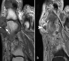 Typische Gichtmanifestation an der Großzehe mit Tophusstachel (Pfeil) und großem Tophus, in welchem Uratablagerungen identifiziert werden können (Pfeilspitze). T1-gewichtete Sequenz vor (a) und nach (b) Kontrastmittelgabe, letztere mit Fettsuppression.