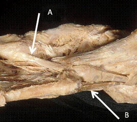 Ansatz des M. peroneus longus (A) und brevis (B) von plantar.