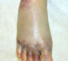 Massive Schwellung und Hämatomverfärbung 2 Tage nach 2-Band-Verletzung.