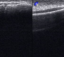 Abgehobenes Periost mit periostalem Hämatom (rechts) mit Gegenseite (links). Die Kortikalis wird unterbrochen von der noch offenen Wachstumsfuge der Fibula.