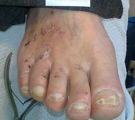 Verbrennungen am Fuß bei diabetischer Neuropathie