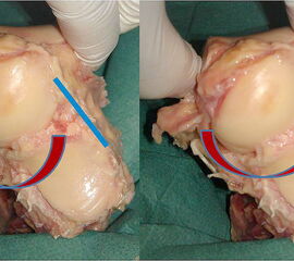 Die„scheibenwischerartigen Bewegungen“ des zervikalen Bands (blau).