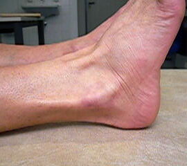 Luxation der Peronealsehnen. Die über die Fibula verlaufende Peronealsehne läßt sich beim Heben des Fußaußenrandes gut tasten (siehe auch Video).