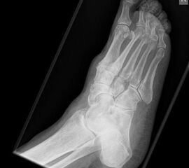 Alte Impressionsfraktur des Os cuboideum mit schweren Knorpelschäden.