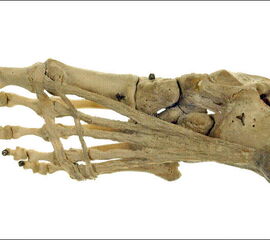 Verspannung des Längsgewölbes durch Plantaraponeurose