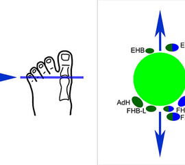 Veränderung der Sehnenvektoren bei Vorliegen eines Hallux varus<br><br>
Abkürzungen:<br>
EBH   M. extensor hallucis brevis<br>
EHL   M. extensor hallucis longus<br>
AdH  M. adductor hallucis<br>
AbH  M. abductor hallucis<br>
FHB-L    lateral